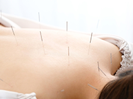 トリガーポイント療法