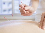 鍼治療(パルス)